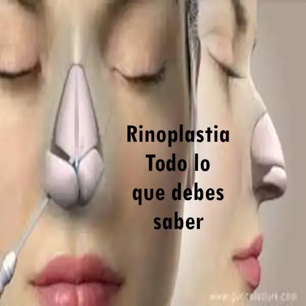 Rinoplastia: Todo lo que debes saber