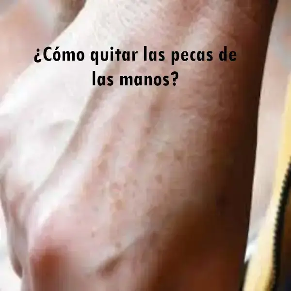 ¿Cómo quitar las pecas de las manos?